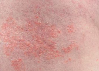 Eczeem & psoriasis