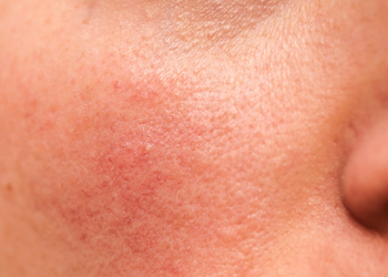 Rosacea en rode huid